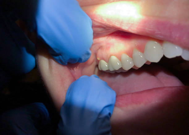 Best Emergency Broken Tooth Repair in Lynden, WA